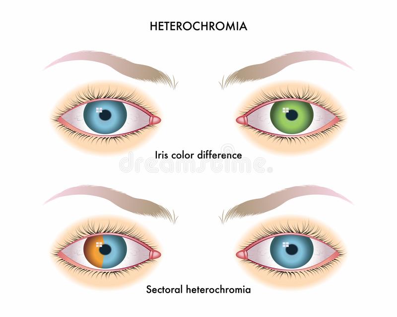 medical-illustration-symptoms-heterochromia-iris-heterochromia-iris-103571276.jpg